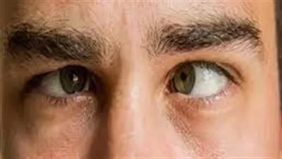 نسبة نجاح عملية الحول للكبار