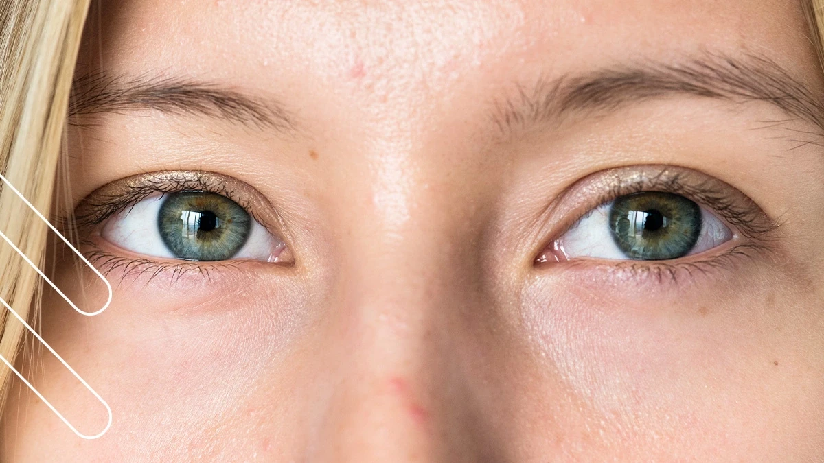 علاج الحول الكاذب عند الكبار