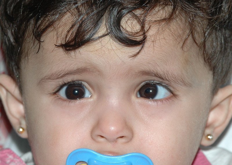 الحول عند الرضع