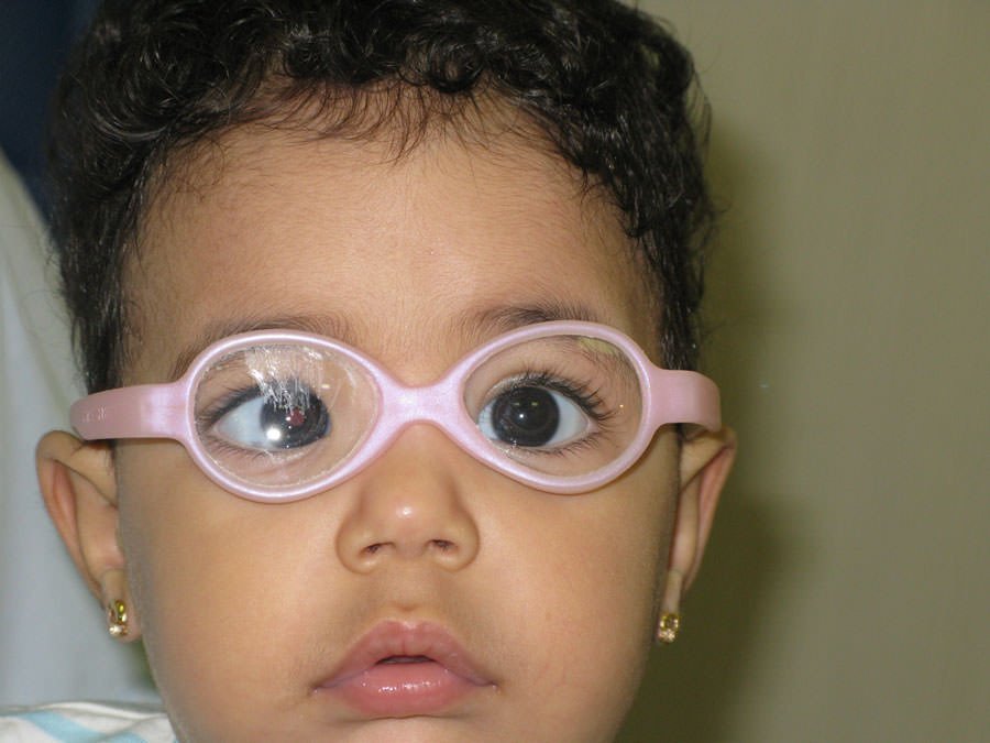 علاج الحول البسيط في العين