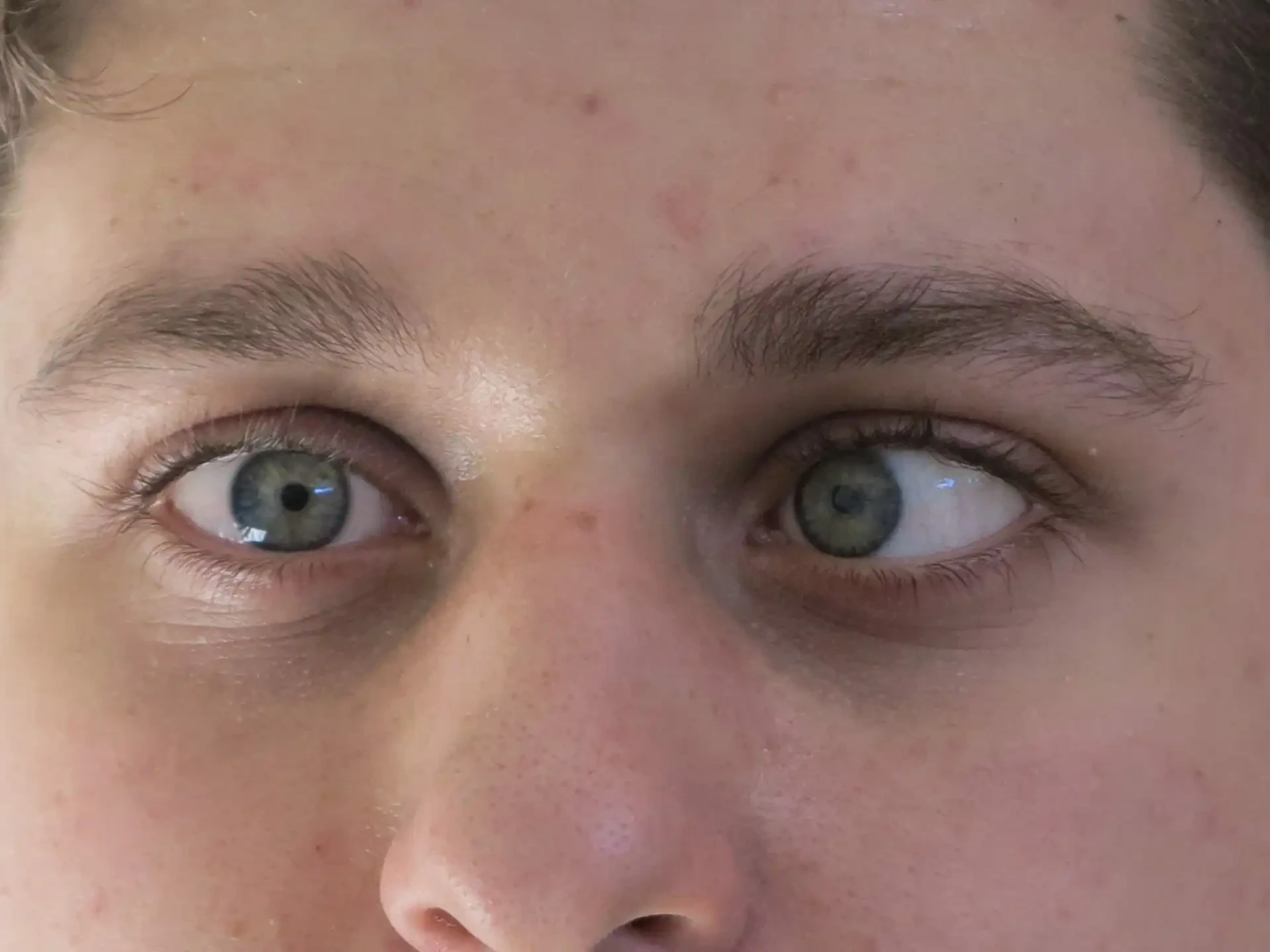 انواع الحول في العين