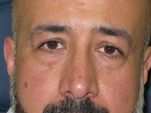 شد الجفون طبيعياً