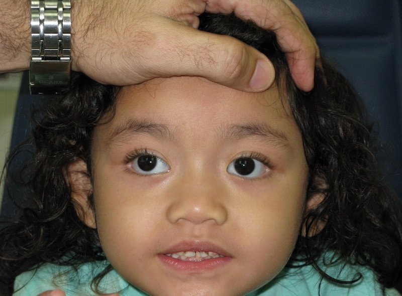 علاج الحول عند الأطفال