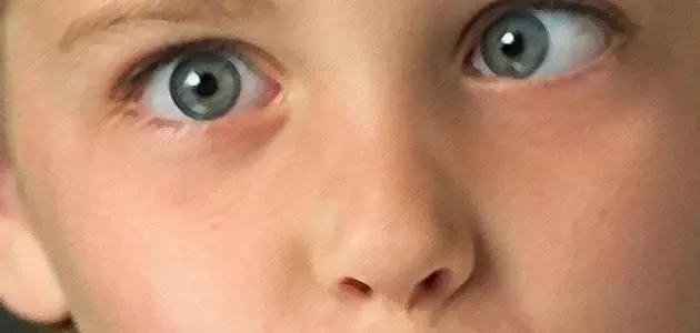 سبب حول العين المفاجئ عند الأطفال الرضع