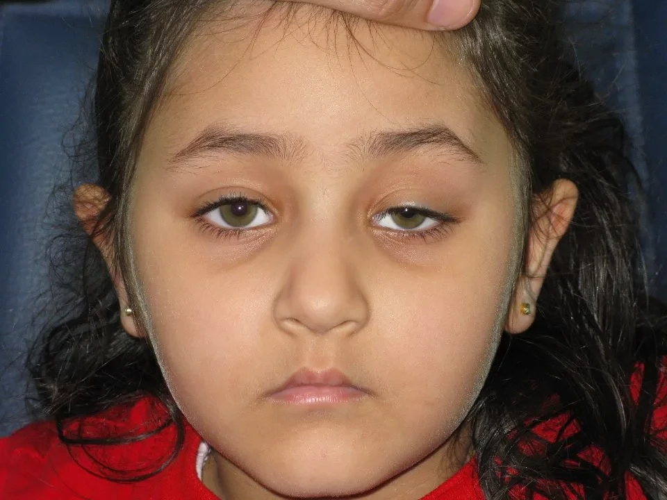 ترهل الجفون