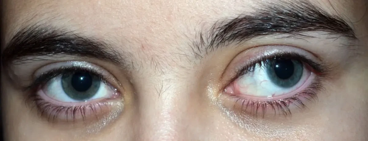 علاج الحول الوحشي عند الكبار