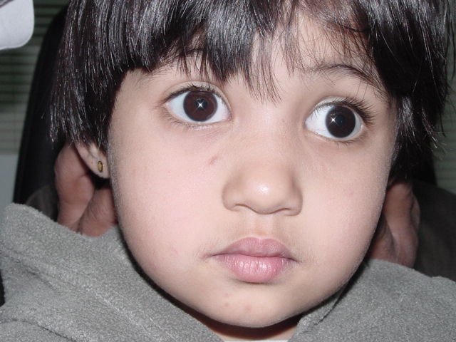 علاج الحول الوحشي