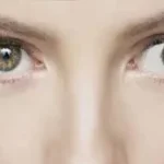 علاج حول العين اليسرى عند الكبار