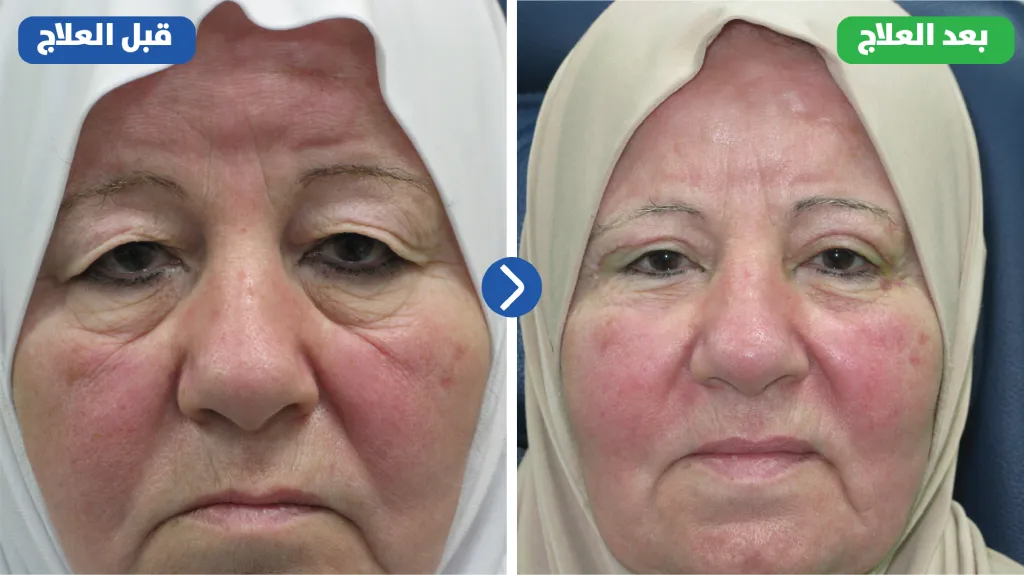 نتيجة عملية شد الجفن العلوي قبل وبعد