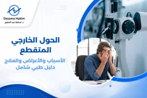 رسم توضيحي يظهر انحراف العين اليسرى للخارج في حالة الحول الخارجي المتقطع، مع سهم يوضح اتجاه الانحراف وعينين تبدوان طبيعيتين في الوضع الآخر.