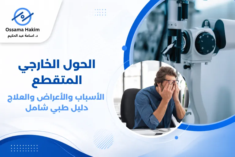 رسم توضيحي يظهر انحراف العين اليسرى للخارج في حالة الحول الخارجي المتقطع، مع سهم يوضح اتجاه الانحراف وعينين تبدوان طبيعيتين في الوضع الآخر.