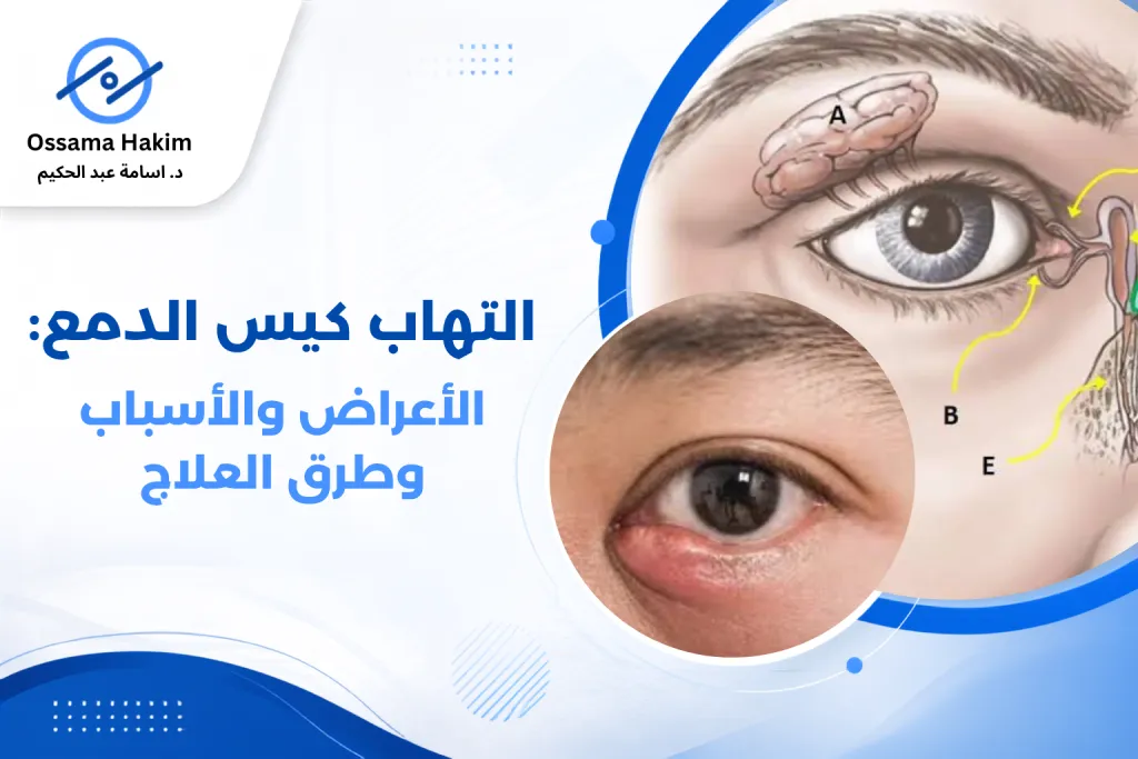 صورة توضيحية لالتهاب كيس الدمع تظهر تورم واحمرار في المنطقة بين العين والأنف