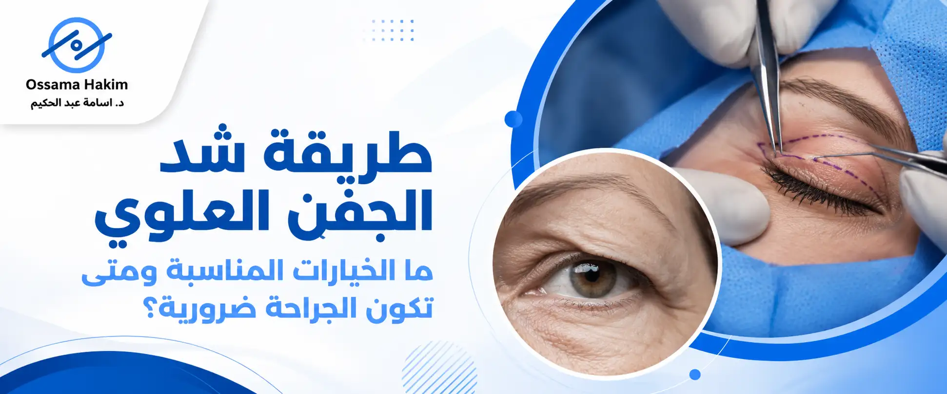طريقة شد الجفن العلوي